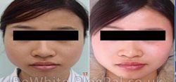 Bleaching skin cream for Zimbabwe