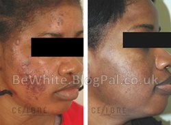Best skin lighteners for Somali people