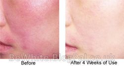 Top whitening cream for Somalian women