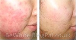 Effective whitening cream for Malawi men
