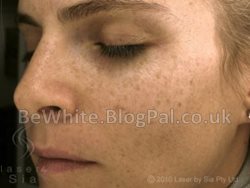 Brightening complexion