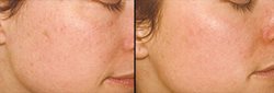 Skin brightening for Zimbabwean