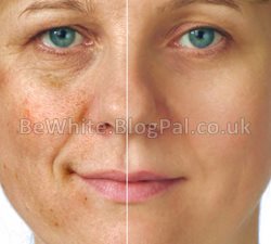 Skin bleaching lotion for Black Trinidadians women