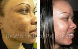 The best whitening cream for Ghanaian people