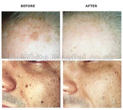 Bleaching cream for Malawian people