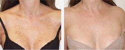 Hyperpigmentation creams for Congo men