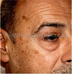 Skin treatment for Somali woman