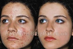 Skin treatments for Pakistani women