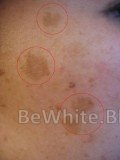 Bleaching your skin for Filipino people