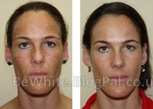 Body skin whitening for Somali men