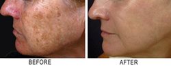 Whitening black skin creams for Indian woman