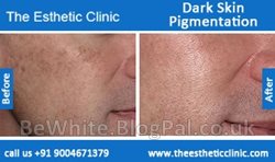 Natural skin lightening cream for Somalia