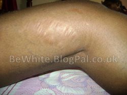 Strong bleaching cream for Filipino people