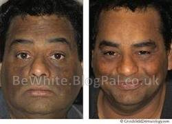 Whitening skin creams for Pakistani people