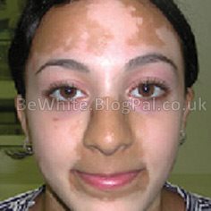 Skin brightening cream for dark skin