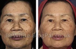Dark spots remover creams for Bangladeshi women