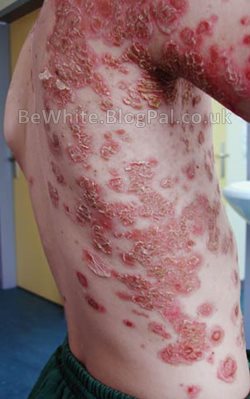 Bleach skin for Zambia women