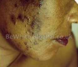 Natural skin lightener for Zambia women