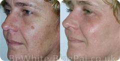 Bleaching creams for face