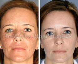 Natural skin lighteners for Zambian woman