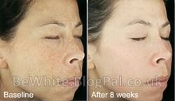 Best skin lightening for Filipino people