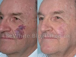 Natural skin whitening cream for Malawian women