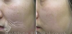Body cream whitening for dark skin