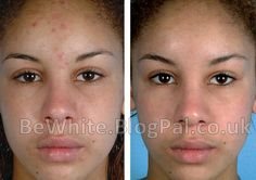 Best skin lightening for Ghana women