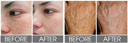Whitening arm creams for Bangladeshi woman