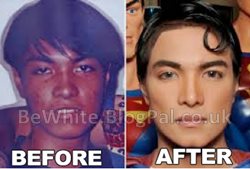 Best skin bleach for Bangladeshi