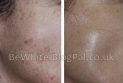 Best bleaching cream for Somali