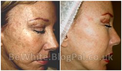 Bleaching cream with hydroquinone for Zimbabwe
