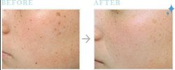 Effective skin whitening for Black Jamaican people