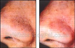 Bleaching cream with hydroquinone for Bangladeshi people