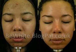 Skin products for Black Trinidadians women