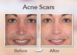 Best whitening products for Zambian
