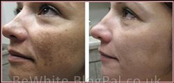 Lightening skin creams for Somali men