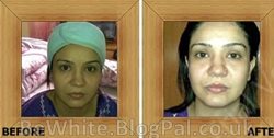 Revitol skin brightener for Zimbabwe women