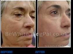 Bleaching black skin creams for Ghana