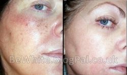 Skin brightening for Zambian women