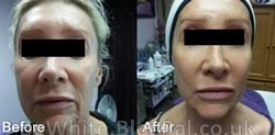 Face lightening cream for Malawi