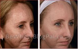 The best skin whitening cream for Indian men