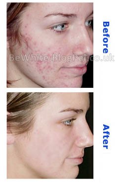 Bleaching neck cream for Black Africans