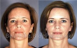 Best skin lightening for Malawi women
