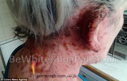 Whitening treatment for Malaysian woman