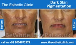 Facial whitening cream for Ghanaian
