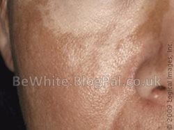 Dark spots remover creams for Somali women