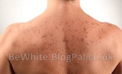 Dark spots remover