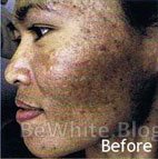 Skin lightening cream uk for Black people