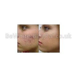 Uneven skin tone creams for Jamaican women